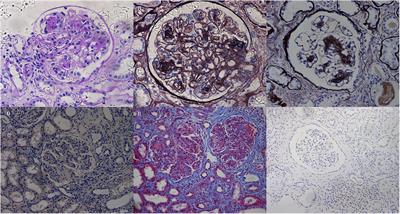 Clinicopathological manifestations of coexistent monoclonal immunoglobulin deposition disease and immunotactoid glomerulopathy